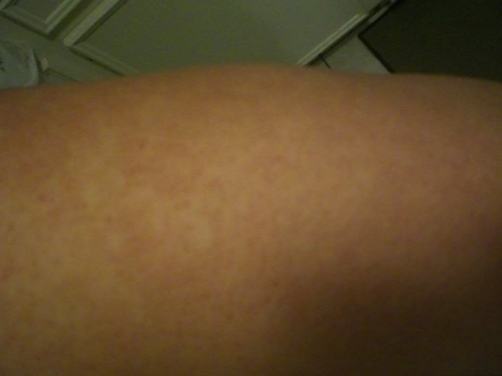 keratosis pilaris natural cure