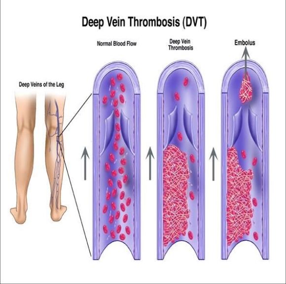 Tips to Prevent Deep Vein Thrombosis During Travel - Our Family World